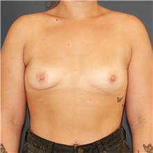 Breast Augmentation Before Photo by Steve Laverson, MD, FACS; Rancho Santa Fe, CA - Case 49131