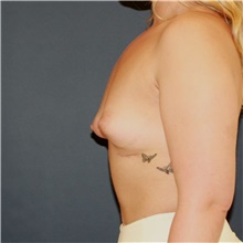 Breast Augmentation Before Photo by Steve Laverson, MD, FACS; Rancho Santa Fe, CA - Case 49131