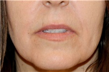 Lip Augmentation/Enhancement Before Photo by Steve Laverson, MD, FACS; Rancho Santa Fe, CA - Case 49185