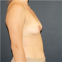 Breast Augmentation Before Photo by Steve Laverson, MD, FACS; Rancho Santa Fe, CA - Case 49196