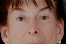 Eyelid Surgery After Photo by Steve Laverson, MD, FACS; Rancho Santa Fe, CA - Case 49243