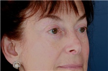 Eyelid Surgery After Photo by Steve Laverson, MD, FACS; Rancho Santa Fe, CA - Case 49243