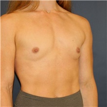 Breast Augmentation Before Photo by Steve Laverson, MD, FACS; Rancho Santa Fe, CA - Case 49245