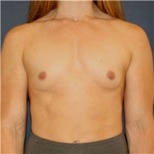 Breast Augmentation Before Photo by Steve Laverson, MD, FACS; Rancho Santa Fe, CA - Case 49245