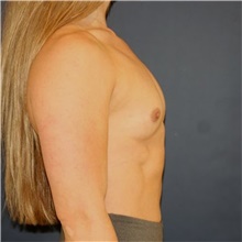 Breast Augmentation Before Photo by Steve Laverson, MD, FACS; Rancho Santa Fe, CA - Case 49245