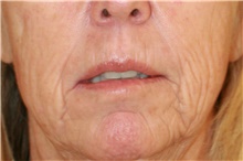 Lip Augmentation/Enhancement Before Photo by Steve Laverson, MD, FACS; Rancho Santa Fe, CA - Case 49280