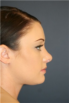 Rhinoplasty After Photo by Steve Laverson, MD, FACS; ,  - Case 50281
