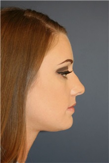 Rhinoplasty Before Photo by Steve Laverson, MD, FACS; ,  - Case 50281