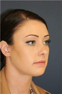 Rhinoplasty After Photo by Steve Laverson, MD, FACS; Rancho Santa Fe, CA - Case 50281