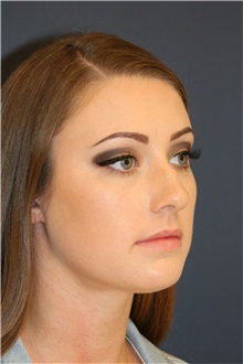 Rhinoplasty Before Photo by Steve Laverson, MD, FACS; Rancho Santa Fe, CA - Case 50281