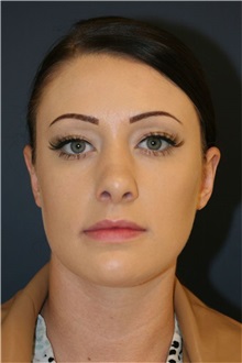 Rhinoplasty After Photo by Steve Laverson, MD, FACS; Rancho Santa Fe, CA - Case 50281