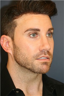 Rhinoplasty After Photo by Steve Laverson, MD, FACS; ,  - Case 50317