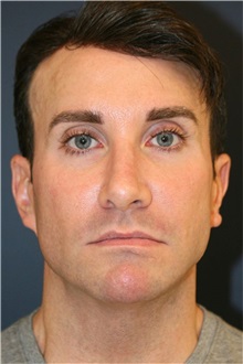 Rhinoplasty Before Photo by Steve Laverson, MD, FACS; ,  - Case 50317