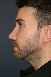 Rhinoplasty After Photo by Steve Laverson, MD, FACS; ,  - Case 50324