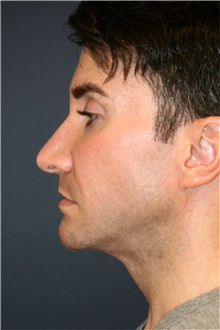Rhinoplasty Before Photo by Steve Laverson, MD, FACS; ,  - Case 50324