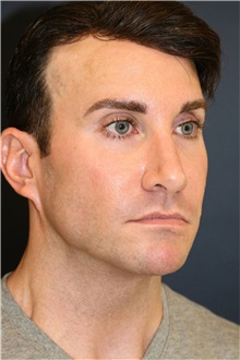Rhinoplasty Before Photo by Steve Laverson, MD, FACS; ,  - Case 50324