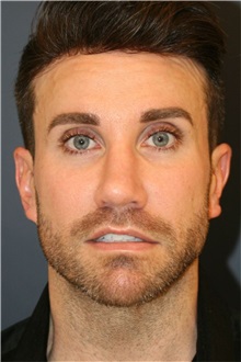 Rhinoplasty After Photo by Steve Laverson, MD, FACS; ,  - Case 50324