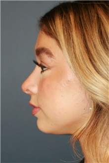 Rhinoplasty After Photo by Steve Laverson, MD, FACS; ,  - Case 50325