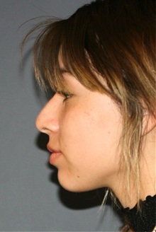 Rhinoplasty Before Photo by Steve Laverson, MD, FACS; ,  - Case 50325