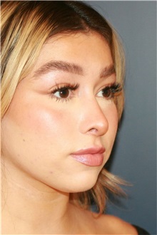 Rhinoplasty After Photo by Steve Laverson, MD, FACS; ,  - Case 50325