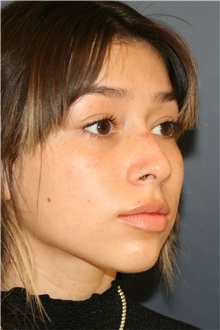 Rhinoplasty Before Photo by Steve Laverson, MD, FACS; ,  - Case 50325