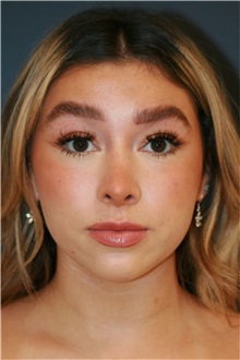 Rhinoplasty After Photo by Steve Laverson, MD, FACS; ,  - Case 50325