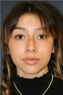 Rhinoplasty Before Photo by Steve Laverson, MD, FACS; ,  - Case 50325