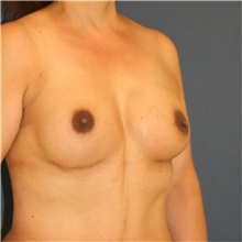 Breast Augmentation After Photo by Steve Laverson, MD, FACS; ,  - Case 50383