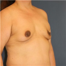 Breast Augmentation Before Photo by Steve Laverson, MD, FACS; ,  - Case 50383