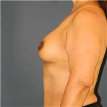 Breast Augmentation After Photo by Steve Laverson, MD, FACS; ,  - Case 50383