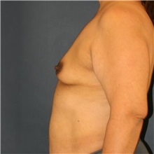 Breast Augmentation Before Photo by Steve Laverson, MD, FACS; ,  - Case 50383
