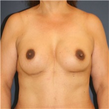 Breast Augmentation After Photo by Steve Laverson, MD, FACS; ,  - Case 50383