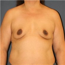 Breast Augmentation Before Photo by Steve Laverson, MD, FACS; ,  - Case 50383