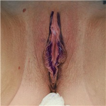 Surgery for Genitourinary Diseases Before Photo by Steve Laverson, MD, FACS; ,  - Case 50433