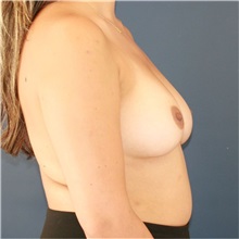 Breast Augmentation Before Photo by Steve Laverson, MD, FACS; ,  - Case 50432