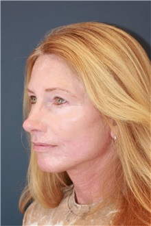 Neck Lift After Photo by Steve Laverson, MD, FACS; Rancho Santa Fe, CA - Case 50498