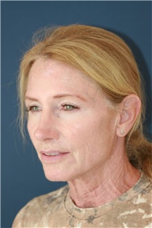 Neck Lift Before Photo by Steve Laverson, MD, FACS; Rancho Santa Fe, CA - Case 50498