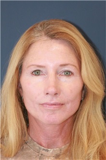 Neck Lift After Photo by Steve Laverson, MD, FACS; Rancho Santa Fe, CA - Case 50498