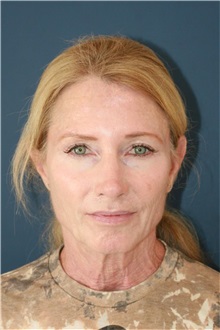 Neck Lift Before Photo by Steve Laverson, MD, FACS; Rancho Santa Fe, CA - Case 50498