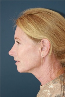 Neck Lift Before Photo by Steve Laverson, MD, FACS; Rancho Santa Fe, CA - Case 50498