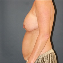 Mommy Makeover Before Photo by Steve Laverson, MD, FACS; Rancho Santa Fe, CA - Case 50650