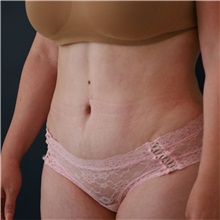 Tummy Tuck After Photo by Steve Laverson, MD, FACS; Rancho Santa Fe, CA - Case 50832