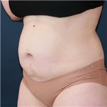 Tummy Tuck Before Photo by Steve Laverson, MD, FACS; Rancho Santa Fe, CA - Case 50832