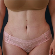 Tummy Tuck After Photo by Steve Laverson, MD, FACS; Rancho Santa Fe, CA - Case 50832