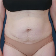 Tummy Tuck Before Photo by Steve Laverson, MD, FACS; Rancho Santa Fe, CA - Case 50832
