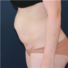 Tummy Tuck Before Photo by Steve Laverson, MD, FACS; Rancho Santa Fe, CA - Case 50832