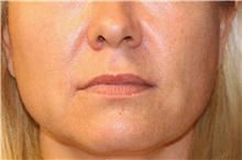 Lip Augmentation/Enhancement After Photo by Steve Laverson, MD, FACS; Rancho Santa Fe, CA - Case 50833