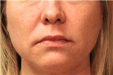 Lip Augmentation/Enhancement Before Photo by Steve Laverson, MD, FACS; Rancho Santa Fe, CA - Case 50833