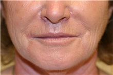 Lip Augmentation/Enhancement After Photo by Steve Laverson, MD, FACS; Rancho Santa Fe, CA - Case 50923