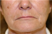 Lip Augmentation/Enhancement Before Photo by Steve Laverson, MD, FACS; Rancho Santa Fe, CA - Case 50923